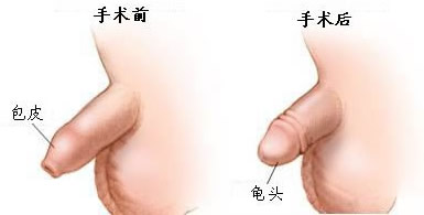 割包皮后的图片